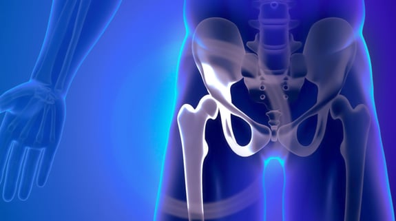 Impingement anca